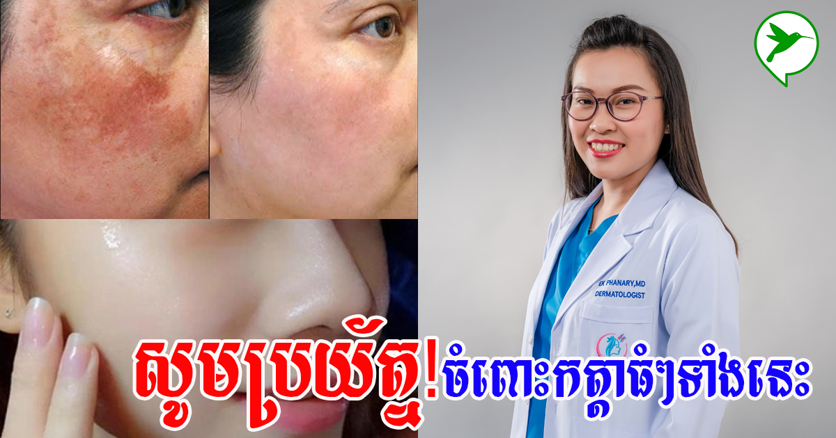 វេជ្ជបណ្ឌិត ឯក ផាណារី៖ កុំធ្វើរឿង ៣ នេះជាដាច់ខាត បើមិនចង់ឱ្យផ្ទៃមុខជាំកែលែងឡើង