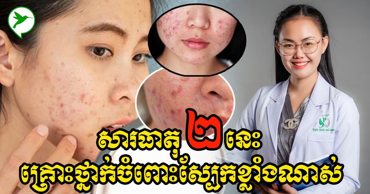 សូមប្រុងប្រយ័ត្ន! សារធាតុទាំង២មានក្នុងឡេលាយ អាចធ្វើឱ្យស្បែករបស់អ្នកជួបហានិភ័យធ្ងន់ធ្ងរ