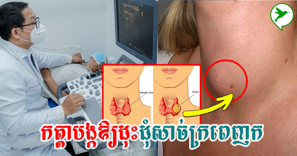 វេជ្ជបណ្ឌិត ថេង ហ៊ាក បង្ហើបពី កត្តាបង្កឱ្យដុះដុំសាច់ក្រពេញក ដែលប្រជាជនខ្មែរត្រូវដឹង