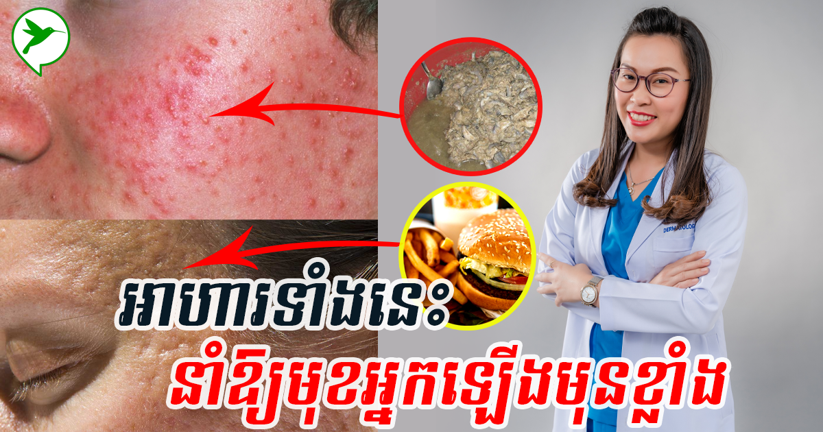 វេជ្ជបណ្ឌិត ឯក ផាណារី បង្ហើបថា អ្នកគួរចៀសវាងអាហារទាំងនេះ ប្រសិនបើមិនចង់ឱ្យផ្ទៃមុខកើតមុន